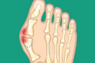 Diagram of effects of bunions