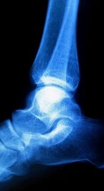 Lorton Podiatrist | Lorton Haglund's Deformity | VA | Dynamic Foot and Ankle Center |
