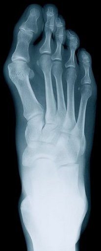 Lorton Podiatrist | Lorton Rheumatoid Arthritis | VA | Dynamic Foot and Ankle Center |